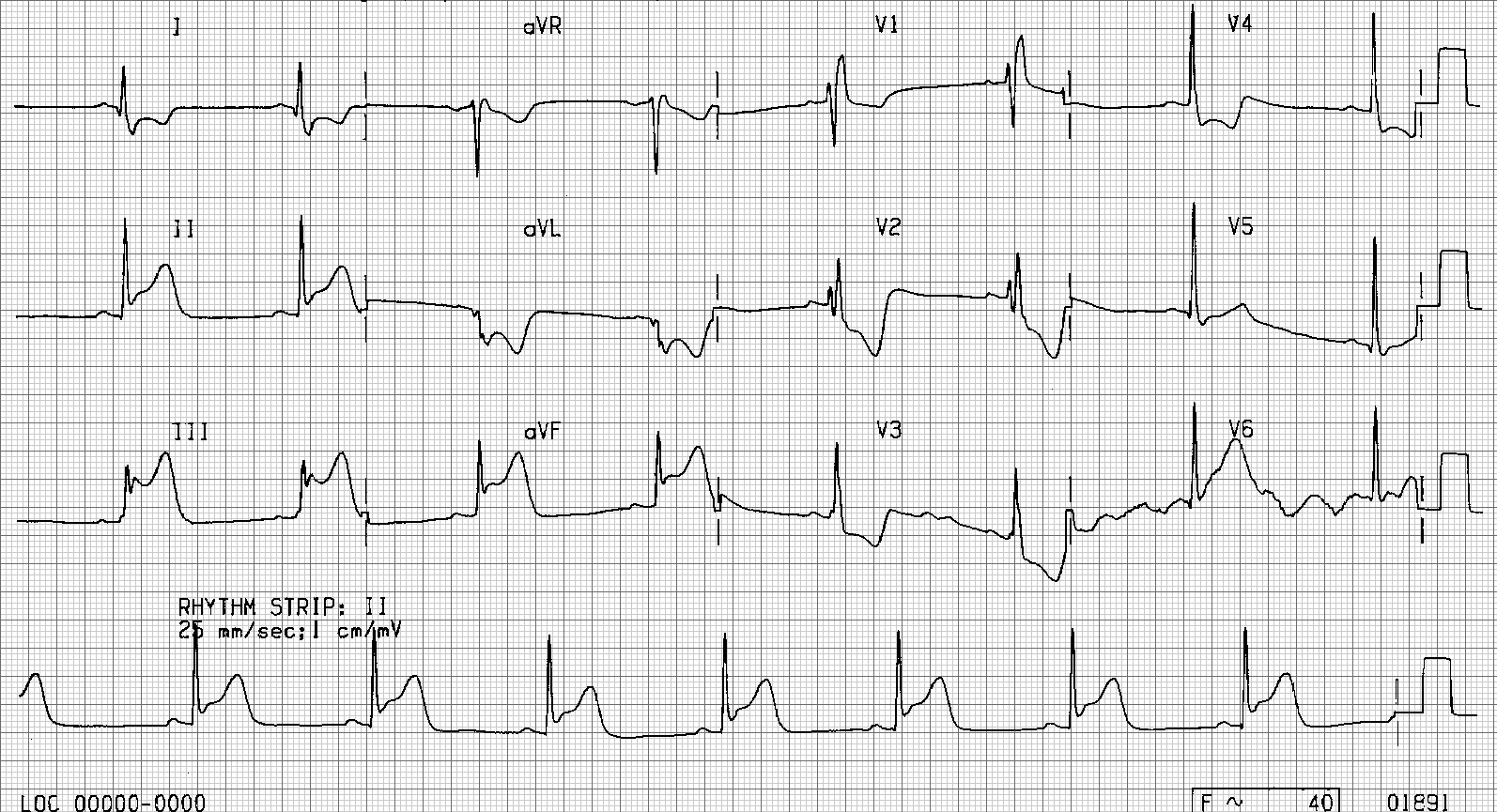 ecglibrary-inferior-myocardial-infarction