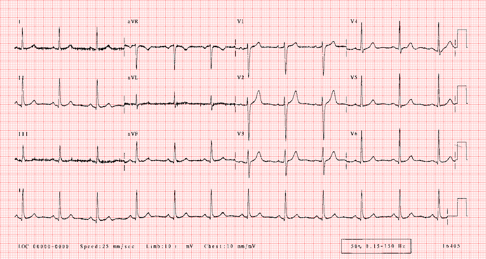 What Does A Normal Ecg Tracing Look Like