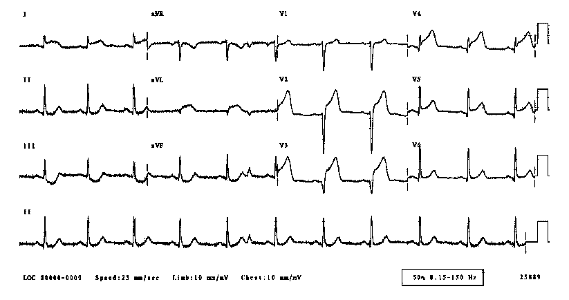 anterior myocardial infarction ecg