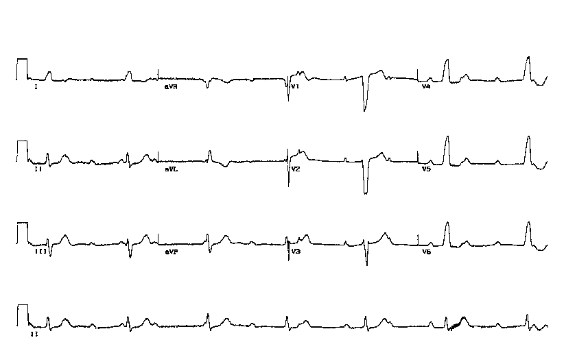 AV block: 3rd degree (complete heart block) • LITFL • ECG Library