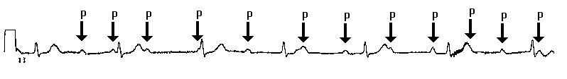 AV block: 3rd degree (complete heart block) • LITFL • ECG Library