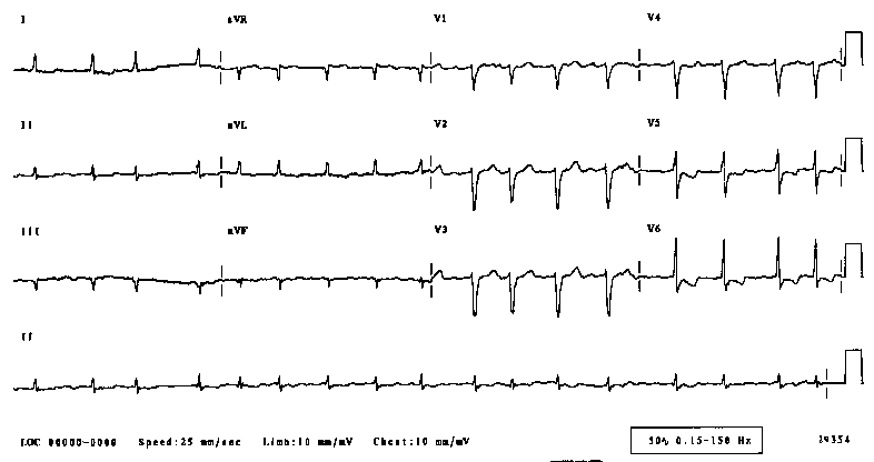 digitalis ecg