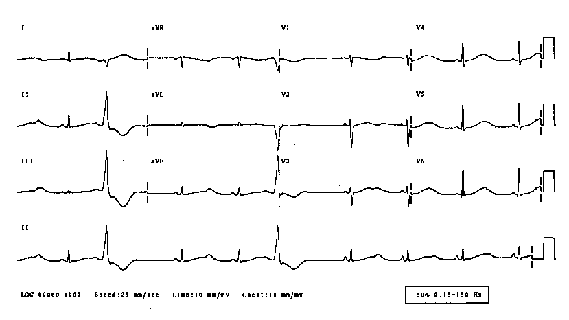 Long QT interval