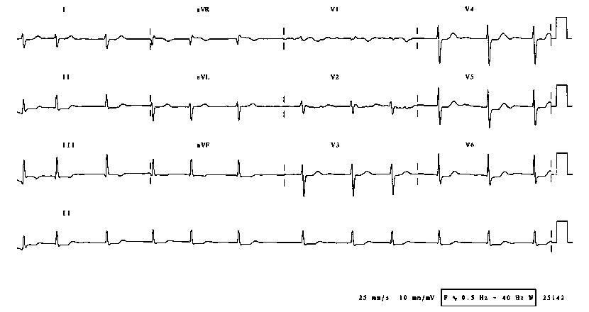 Mitral Stenosis