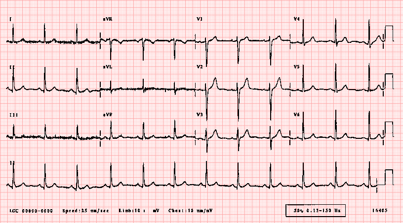 normal ecg reading