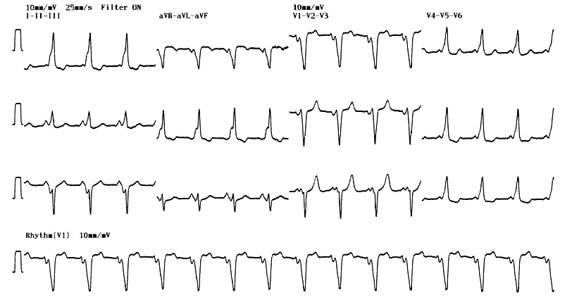 WPW syndrome (anteroseptal pathway)